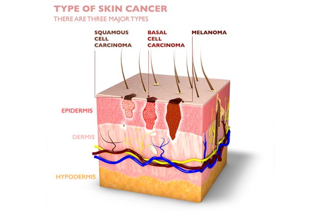 Skin tumors, moles and spots, 3d section of the skin layer. Three types of skin cancer, squamous cell carcinoma, basal cell carcinoma, melanoma. 3d render Skin tumors, moles and spots, 3d section of the skin layer. Three types of skin cancer, squamous cell carcinoma, basal cell carcinoma, melanoma. 3d render