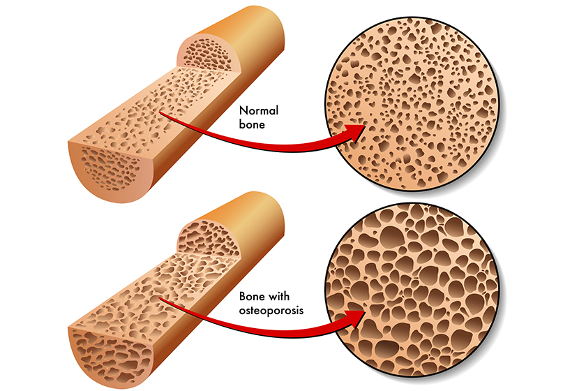 Colorful Osteoporosis scheme