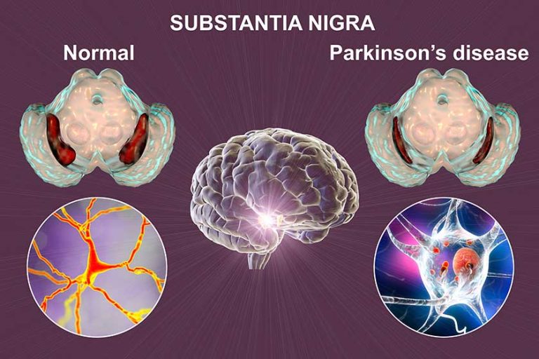 Black substance of the midbrain and its dopaminergic neurons in normal state and in Parkinson’s disease. 3D illustration showing volume decrease and accumulation of Lewy bodies in neurons Black substance of the midbrain and its dopaminergic neurons in normal state and in Parkinson's disease. 3D illustration showing volume decrease and accumulation of Lewy bodies in neurons