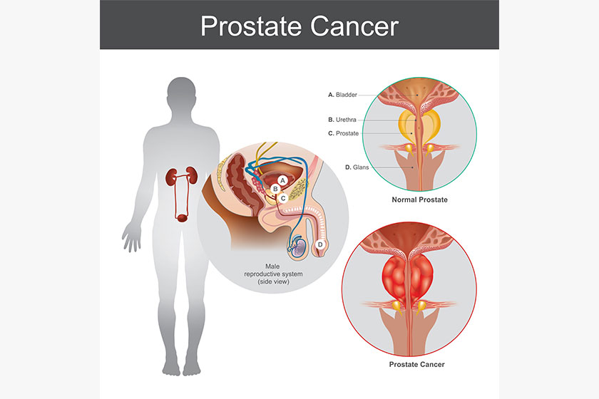 Prostate Cancer. Illustration anatomy body part. Prostate Cancer. Illustration anatomy body part.