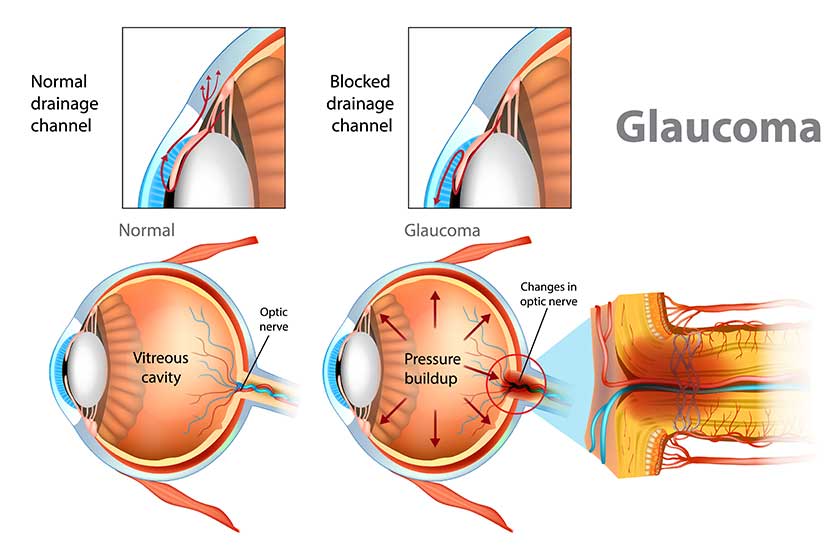 Glaucoma-illustration-showing-open-angle-glaucoma-intraocular-pressure-back-eye Glaucoma-illustration-showing-open-angle-glaucoma-intraocular-pressure-back-eye