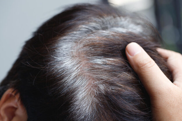 Back view of young people premature gray hair, showing black hoa