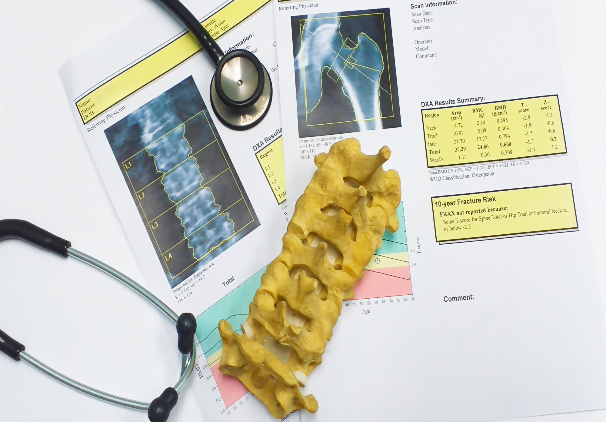 bone density hip and lumbarspine Result Osteoporosis